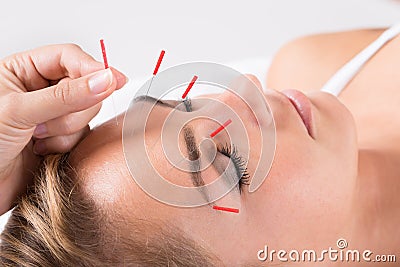 Hand Performing Acupuncture Therapy On Head Stock Photo