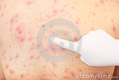 Hand pointing to skin rash Stock Photo