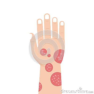 Hand with psoriasis or Eczema. Vector Illustration