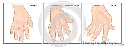 Hand with rheumatoid arthritis Vector Illustration