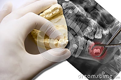 Hand show molar tooth and toothache wisdom tooth Stock Photo