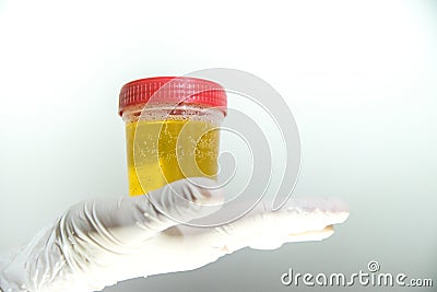 Hand with urine container Stock Photo