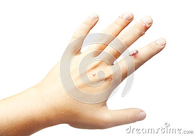 Hand with warts isolated on white background Stock Photo