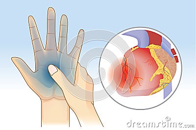 Hand weakness symptom can be caused by heart disease. Vector Illustration