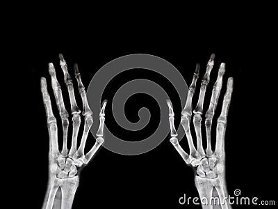 Hand x-ray film from hospital broken bone Stock Photo