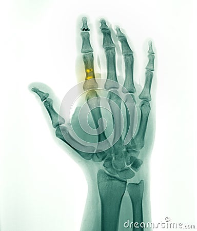 Hand X-ray, flexor tendon repair Stock Photo