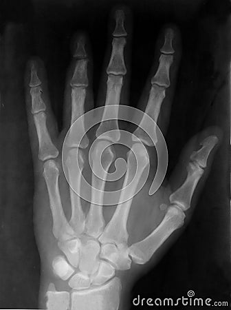 Hand xray Stock Photo