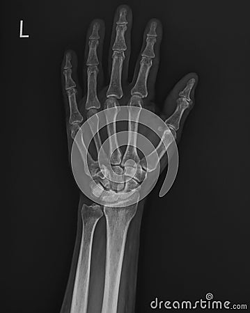 Hand xray film Stock Photo