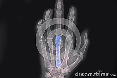 Hand xray showing spiral fractured third metacarpal bone Stock Photo
