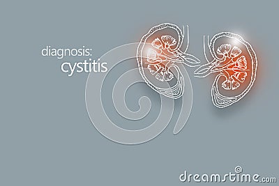 Handrawn medical poster of human kidneys organ with cystitis. Diseases of the genitourinary system. Stock Photo