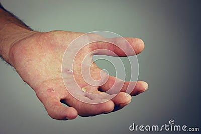 Hands with blister and callus Stock Photo