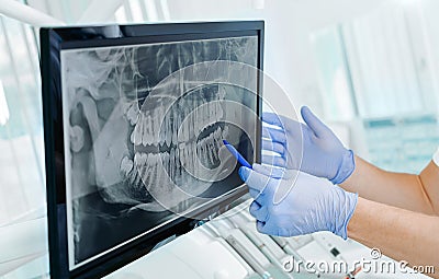 Hands doctor dentist in gloves show the teeth on x-ray on digital screen in dental clinic on light background with medical Stock Photo