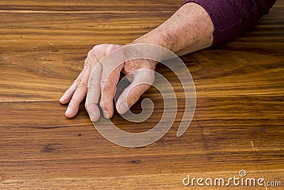 The hands of a male with Psoriatic Arthritis Stock Photo