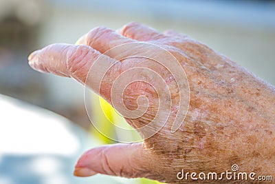 hands of old woman with skin problems Stock Photo