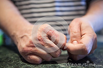 Hands with psoriasis or eczema sickness. Health problems with skin. Stock Photo