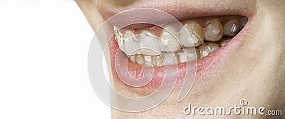 Happy smile of young woman with dental braces aligner Stock Photo
