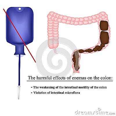 The harmful effects of enemas on the colon in constipation. Feces in the intestines. Infographics. Vector illustration Vector Illustration