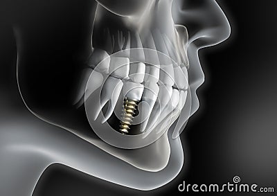Head with dental implant in jaw Stock Photo