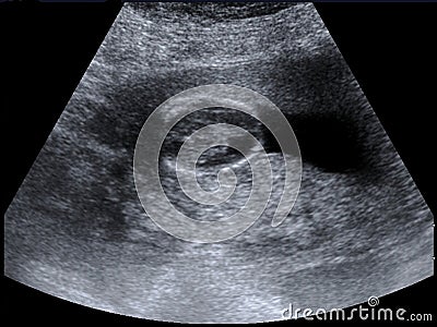 Head of a fetus Stock Photo