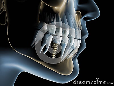 Head and jaw with a dental implant Cartoon Illustration