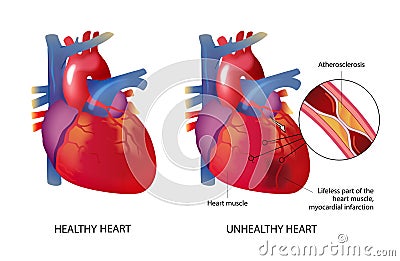 Healhty and unhealthy heart Stock Photo