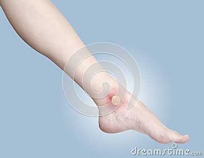 Healing blister on the foot ankle. Stock Photo