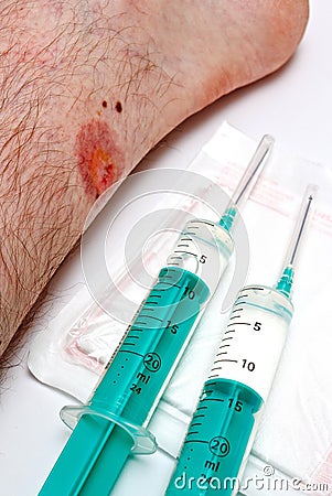 Healing wound Stock Photo