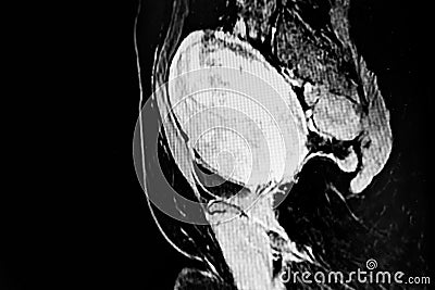 Abdomen-pelvic CT Scan showing uterine tumor (leiomyoma) Stock Photo