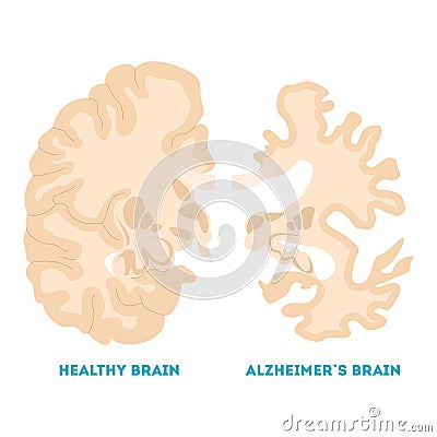 Healthy and alzheimer brain. Neurodegeneration concept illustration Vector Illustration