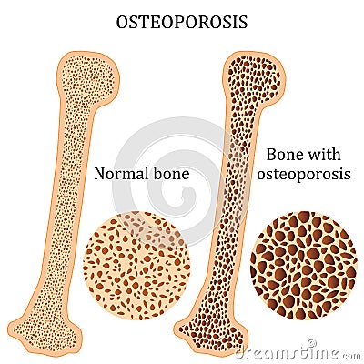 Healthy bone and osteoporosis bone. Vector Illustration