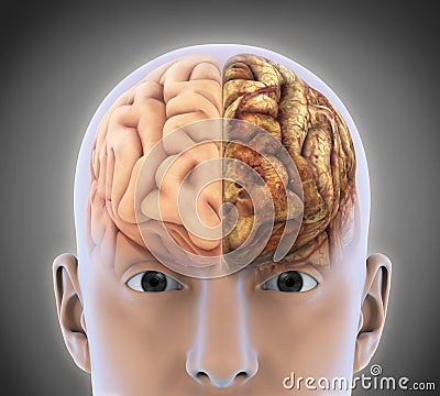 The Healthy Brain and The Unhealthy Brain Stock Photo