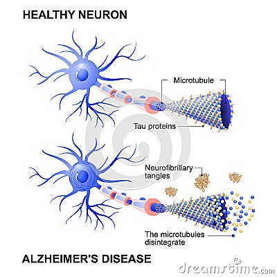 Healthy cell and neurons with Alzheimer`s disease. Tau hypothesi Vector Illustration