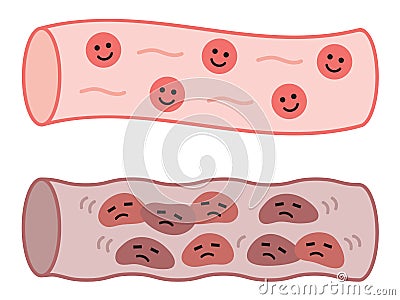 Healthy blood vessel and clogged artery in cute characters. health care concept Vector Illustration