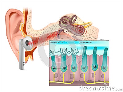 Healthy and damaged hair cells inside cochlea. Tinnitus. Noise-induced hearing loss. . Vector Illustration