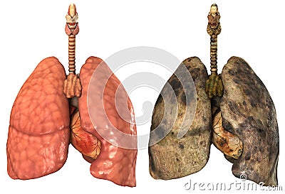 Lungs of a smoker Stock Photo