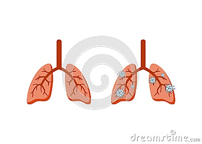 Healthy and diseased lungs Sick lungs infected with cancer virus bacteria coronovirus organ Theme of the medical brochure messages Vector Illustration