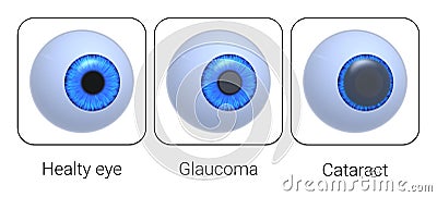 Healthy eye, glaucoma, cataract. Eye deseases. Isolated on white. 3D-rendering. Stock Photo