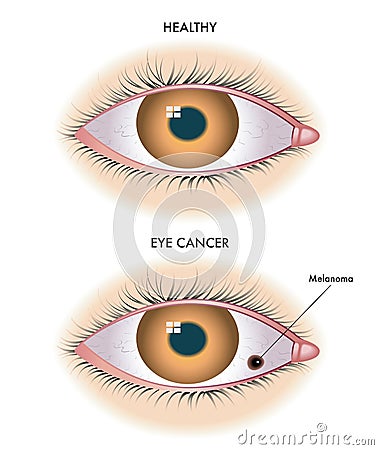 Healthy eye and with melanoma Vector Illustration