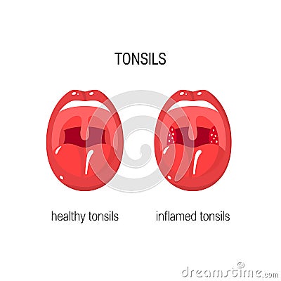 Tonsils vector illustration Vector Illustration