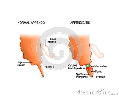 Healthy and Inflamed appendix. Vector Illustration