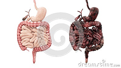 Healthy intestines and disease intestines on white isolate. Autopsy medical concept. Cancer and smoking problem. Stock Photo