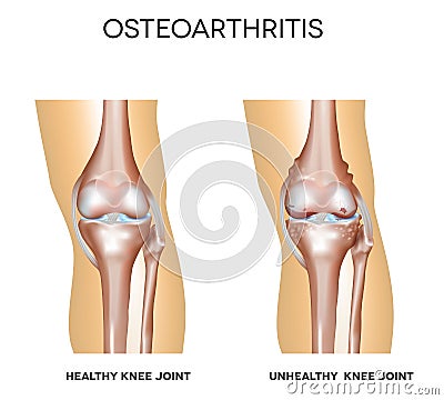 Healthy knee and knee with osteoarthritis Vector Illustration