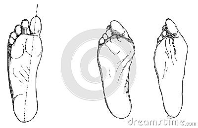 Healthy (lefts) and diseased foot (rights). Stock Photo