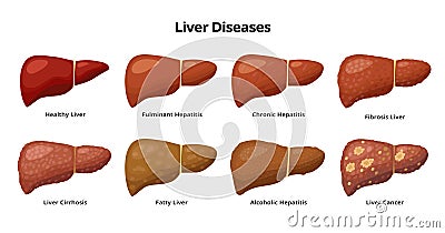 Healthy Liver and Liver diseases - fatty liver, hepatitis, fibrosis, cirrhosis, alcoholic hepatitis, liver cancer - Vector Illustration