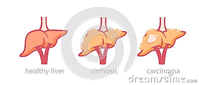 Healthy liver and tumor damaged illustration. Process transformation normal organ into fatty hepatosis and cirrhosis. Vector Illustration