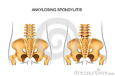 Healthy lower back and ankylosing spondylitis Vector Illustration