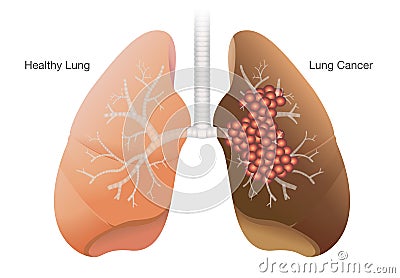 Healthy lung and cancer lung Vector Illustration