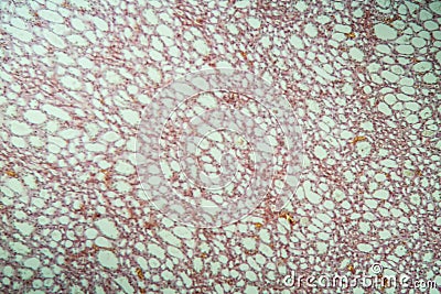 Healthy lung tissue with alveoli Stock Photo