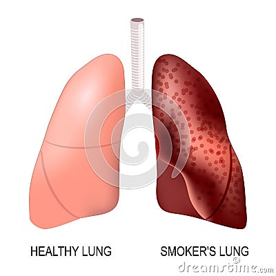 Healthy lungs and smokers lungs Vector Illustration