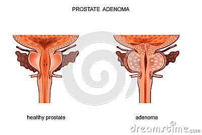 Healthy prostate and BPH Vector Illustration